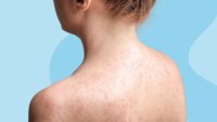 Can I Get Measles if I’m Vaccinated?